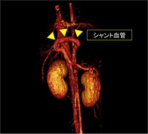 門脈シャント結紮術