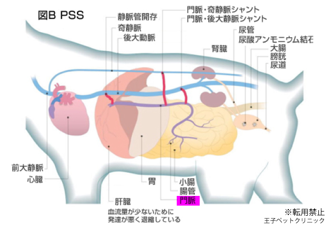 門脈シャント