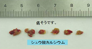 電気水圧衝撃波結石破砕術（EHL）