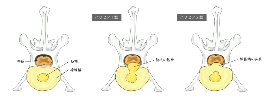 椎間板ヘルニアの分類