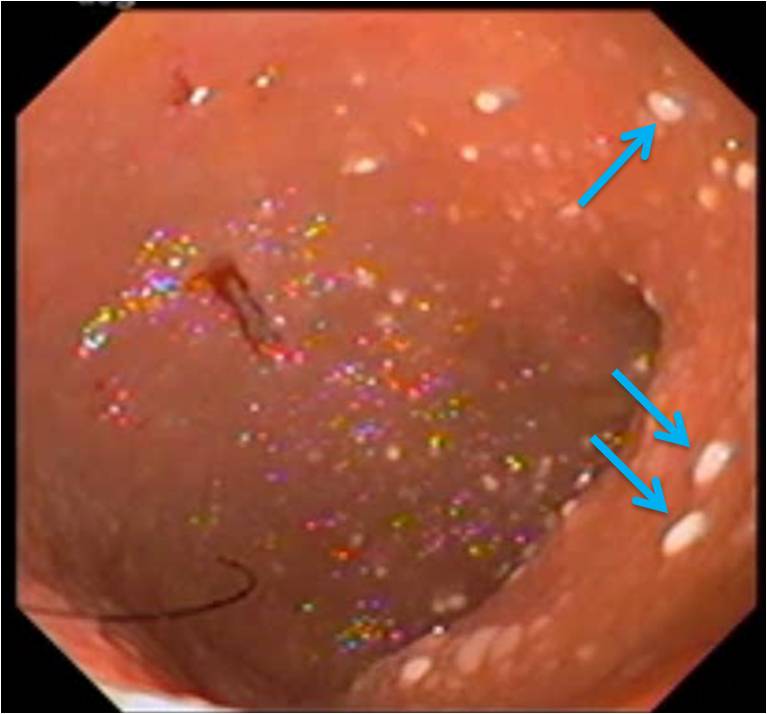 特発性炎症性腸疾患（IBD）