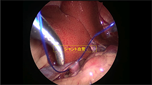 門脈シャント結紮術