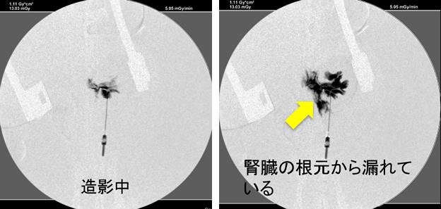 レントゲン