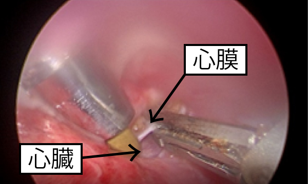 乳び胸（Chylothorax）