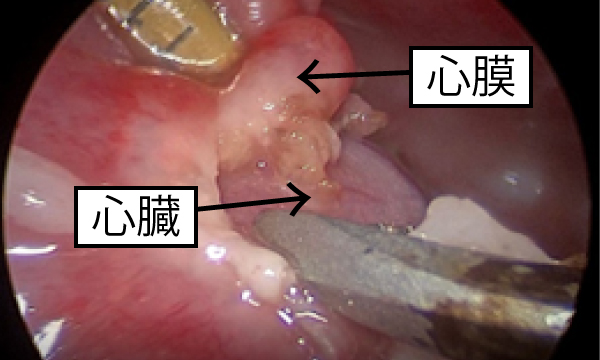 乳び胸（Chylothorax）