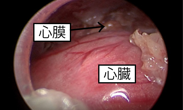 乳び胸（Chylothorax）