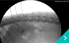 経皮的レーザー椎間板減圧術（PLDD)