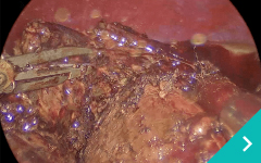 腹腔鏡下胆嚢肝臓がん摘出手術