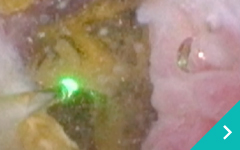 レーザー結石破砕血液透析治療