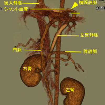 左胃静脈-横隔静脈-後大静脈シャント