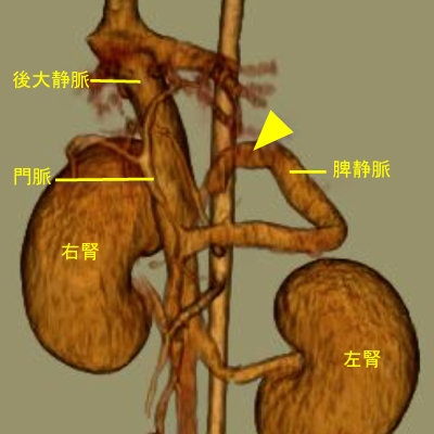 左胃静脈-後大静脈シャント