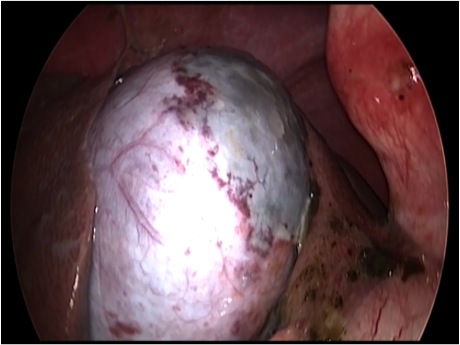 胆嚢から漏れ出た胆汁が腹腔内に確認できます