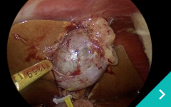 腹腔鏡下胆嚢摘出術