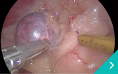 腹腔鏡下副腎摘出術