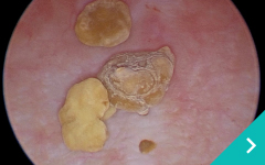 腹腔鏡下膀胱結石摘出術