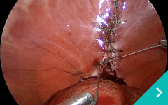 腹腔鏡下心嚢横隔膜ヘルニア手術