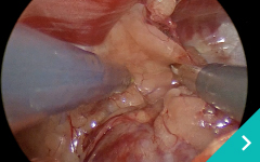 胸腔鏡下胸腺腫切除