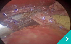 胸腔鏡下心膜切除