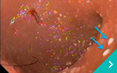 特発性炎症性腸疾患（IBD）