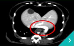 門脈シャントコイル塞栓術