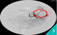 脾動脈コイル塞栓術