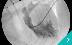 心臓カテーテル