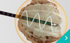 肝臓がんアブレーション治療 