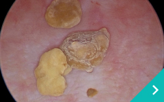 低侵襲尿管・尿道・膀胱結石治療