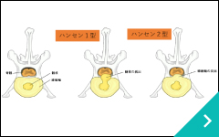 椎間板ヘルニアとは