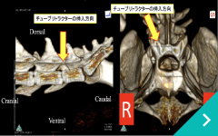 椎間板ヘルニア腹腔鏡下胆嚢肝臓がん摘出手術