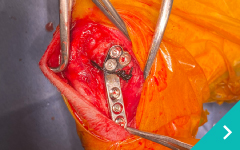 前十字靭帯断裂（TPLO)